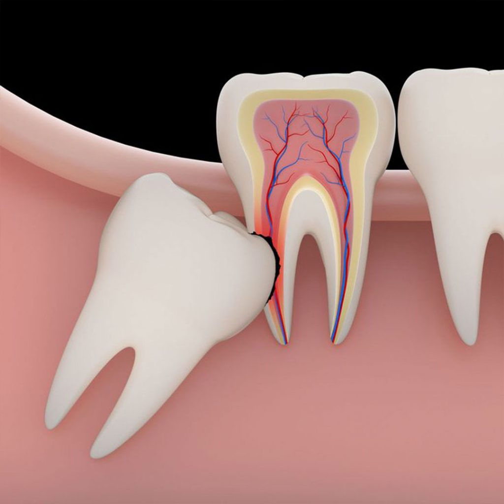 A 3D panoramic X-ray displaying impacted wisdom teeth before surgery in San Diego at Elevated Oral Surgery.