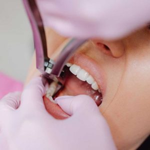 A patient receiving a consultation for painless wisdom teeth removal at Elevated Oral Surgery San Diego using advanced sedation technology.