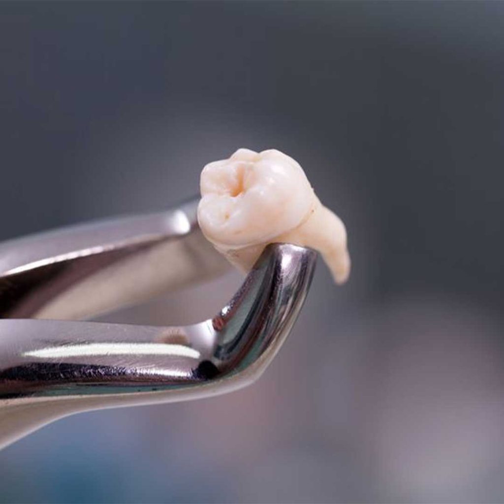 A specialist at Elevated Oral Surgery providing a consultation for clairemont wisdom teeth removal using 3D imaging technology.