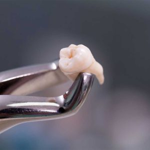 A specialist at Elevated Oral Surgery providing a consultation for clairemont wisdom teeth removal using 3D imaging technology.