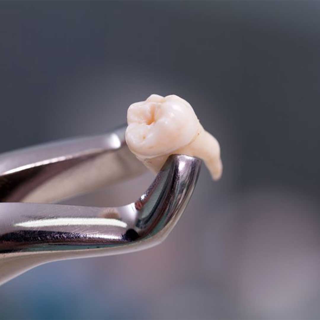 A specialist at Elevated Oral Surgery providing a consultation for clairemont wisdom teeth removal using 3D imaging technology.