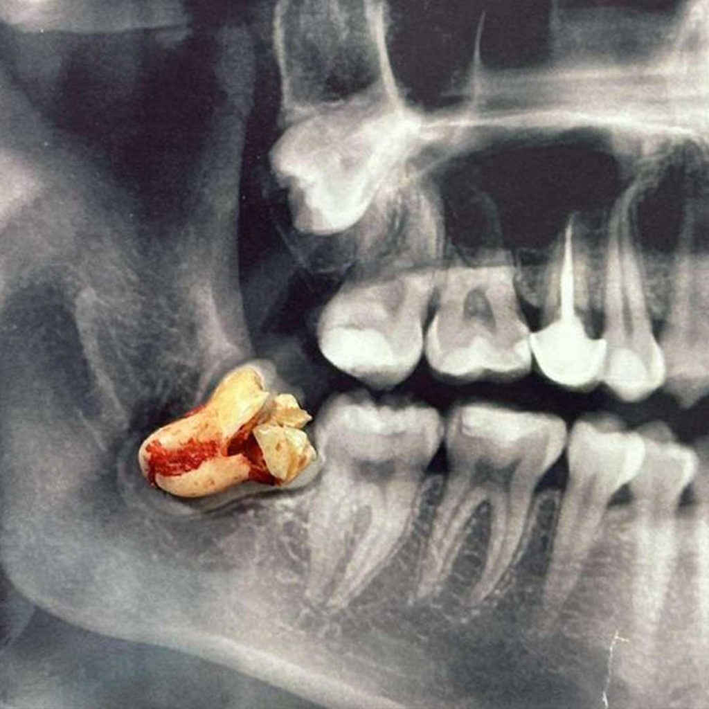 Board-certified oral and maxillofacial surgeons in San Diego using 3D technology for dental implants and wisdom teeth removal.