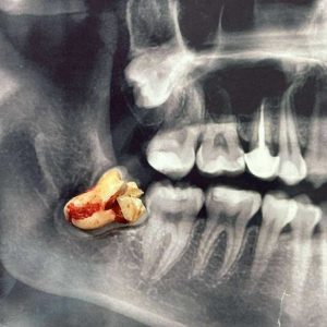 Board-certified oral and maxillofacial surgeons in San Diego using 3D technology for dental implants and wisdom teeth removal.
