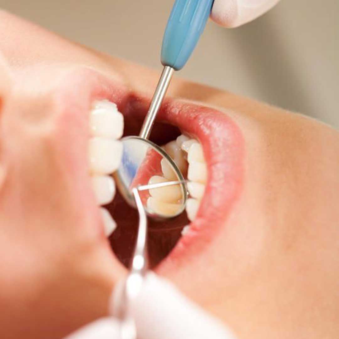 Board-certified oral surgeon in Rancho Bernardo performing a wisdom teeth removal consultation using a 3D CBCT scan.